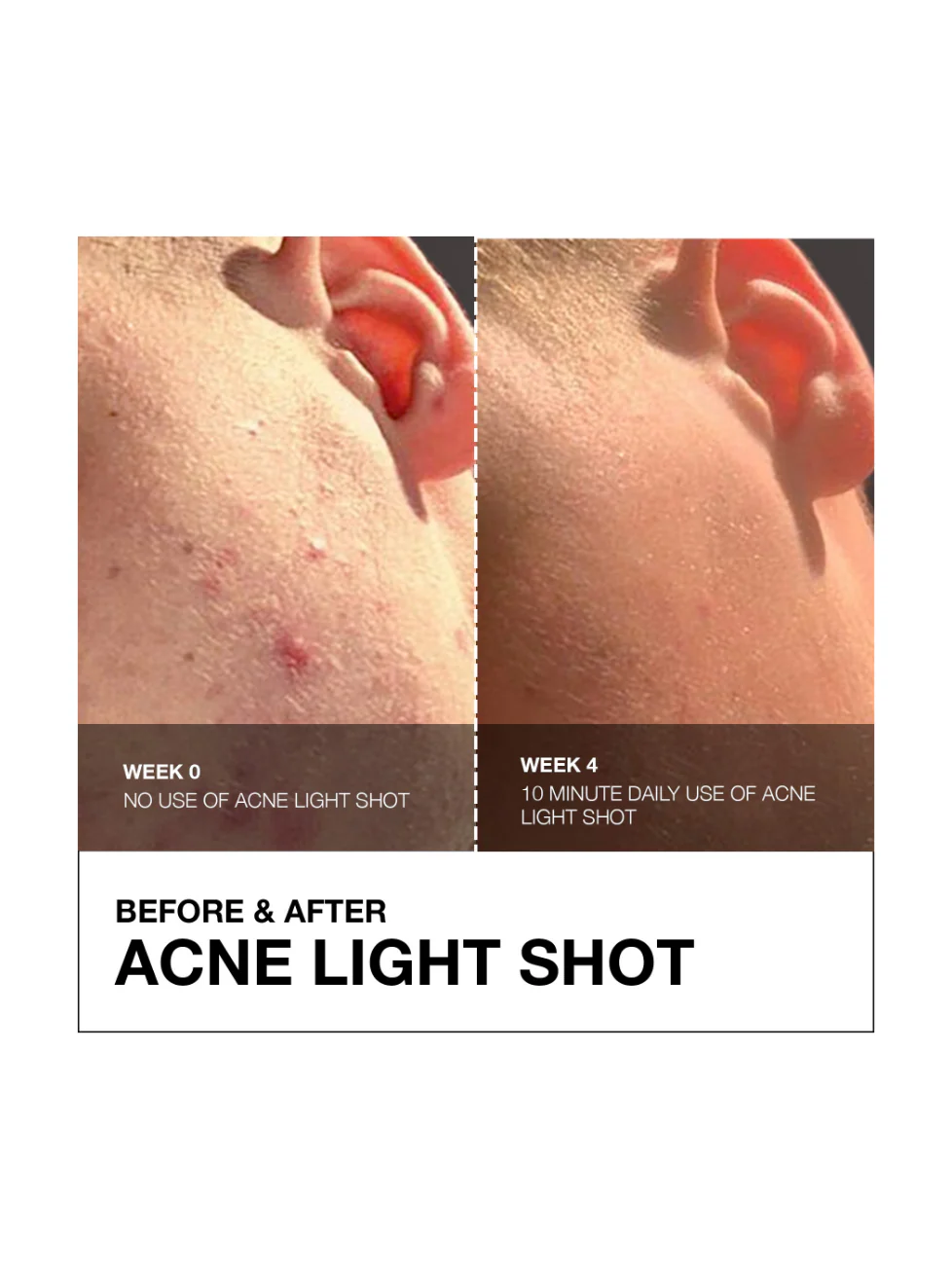 Acne Light Shot - Image 4